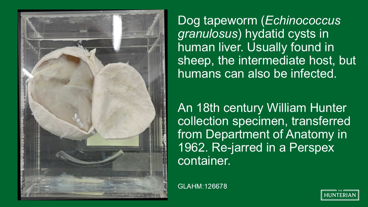 Dog tapeworm hydatid cysts in human liver