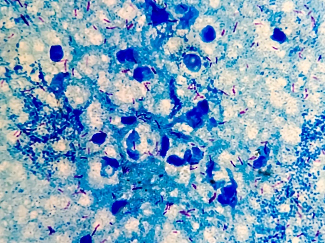 Image of the microbacterium tuberculosis under the microscopr