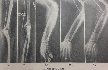 Vascular Surgery scan showing Serial Arteriography of an arm following treatment with streptokinase