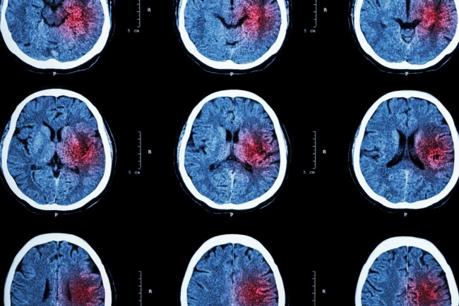 Image of repeated brain scans of patient who has had a stroke