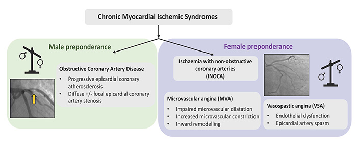 Reappraising Ischemic Heart Disease in Women